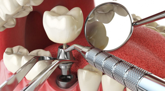 Стоматологическая имплантация зубов, зубные импланты (имплантаты)