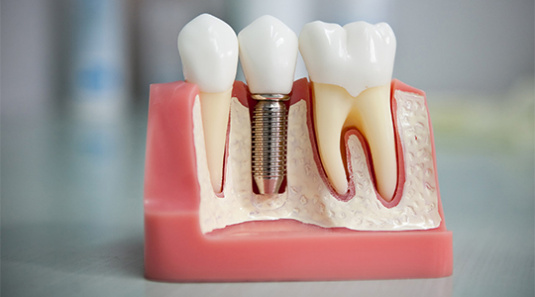 Виды протезирования при частичном отсутствии зубов