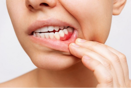 Пародонтоз – что это и как спасти зубы?